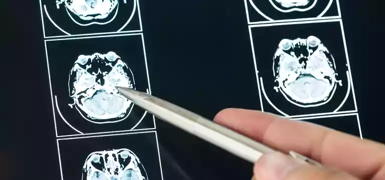 Understanding MRI Stroke Protocol: Things you must know